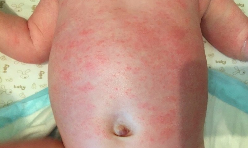 Allergic urticaria to powder